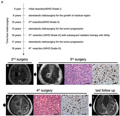 Case report and literature review: exploration of molecular therapeutic targets in recurrent malignant meningioma through comprehensive genetic analysis with Todai OncoPanel